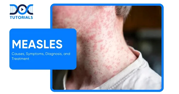 Measles
