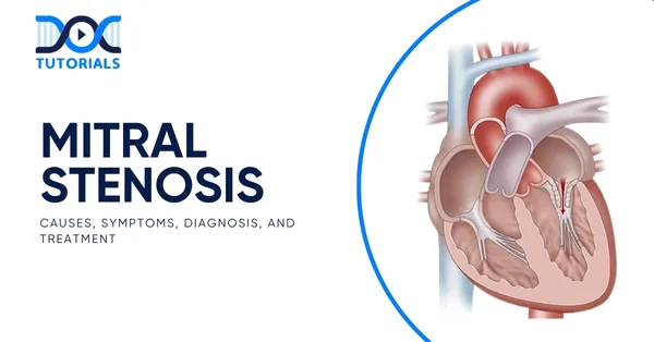 Mitral Stenosis