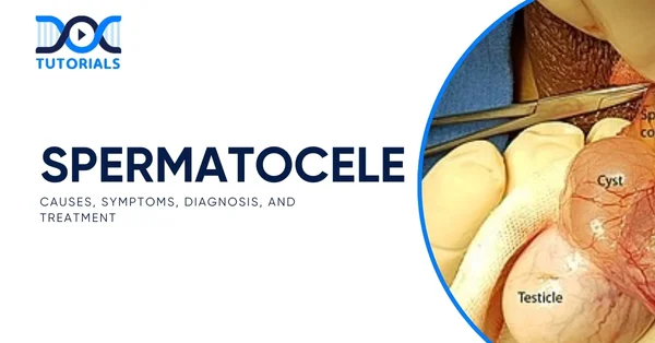 Spermatocele