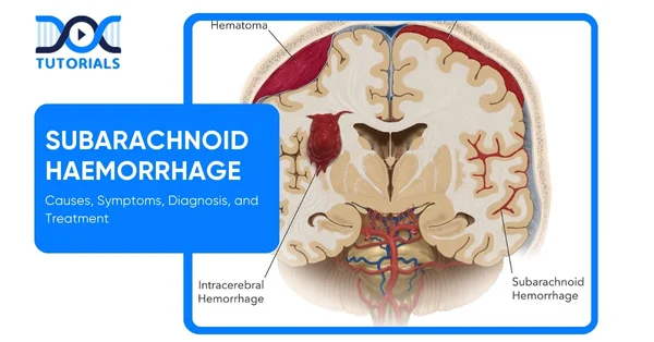 Subarachnoid Haemorrhage