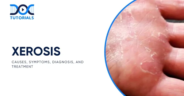 Xerosis