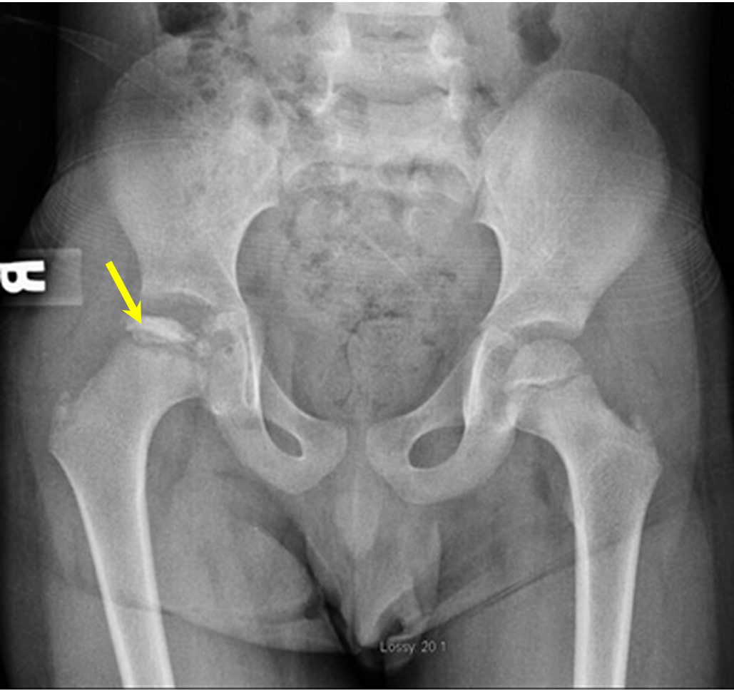 Xray