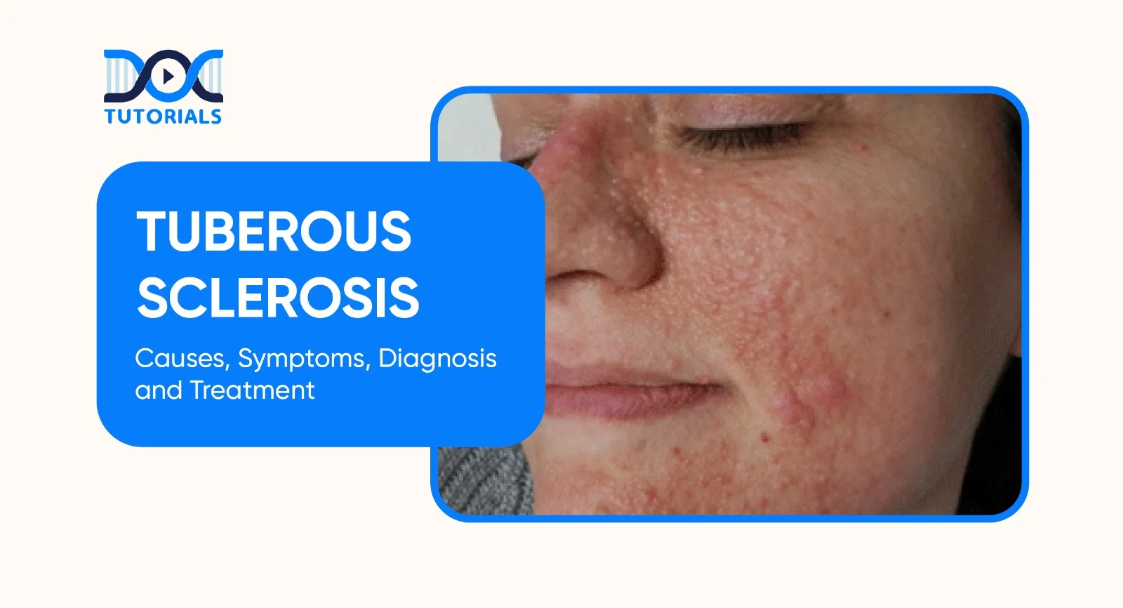 Tuberous Sclerosis