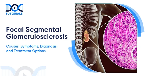 Focal Segmental Glomerulosclerosis