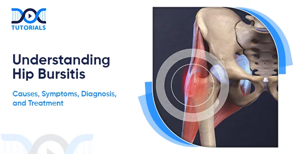 Understanding Hip Bursitis