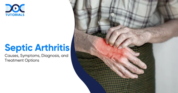 Septic Arthritis | DocTutorials
