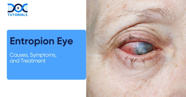 Entropion Eye