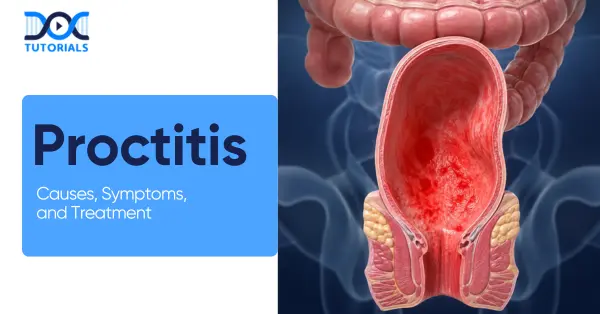 Proctitis Causes Symptoms
