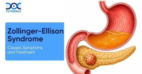 Zollinger Ellison Syndrome
