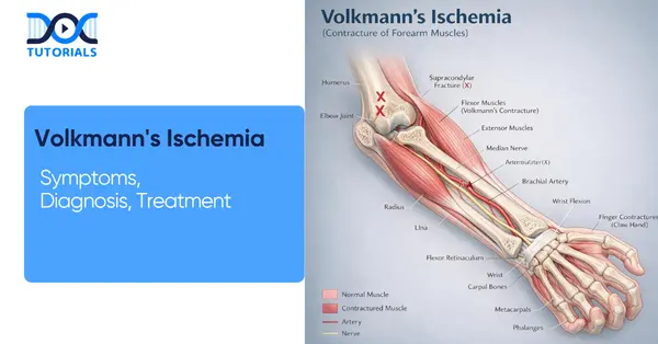 volkmann Ischemia